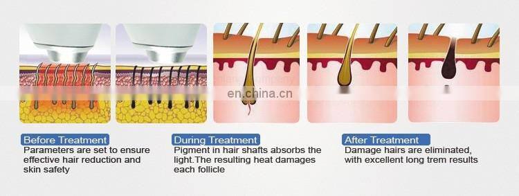 2020 Top-seller Portable 808 Diode Laser Permanent Hair Removal Machine