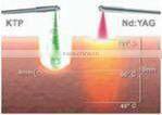 new high energy Q-switched ND YAG laser tattoo removal machine