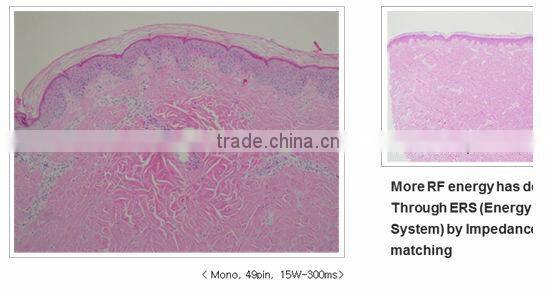 Personal care and beauty series product fractional rf skin lifting machine