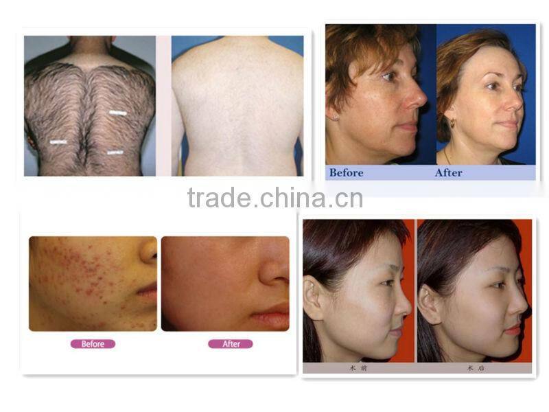 IPL laser hair removal skin rejuvenation skin tightening