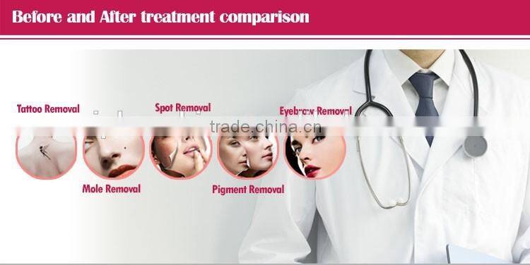 Best-selling nd yag laser pigment removal machine