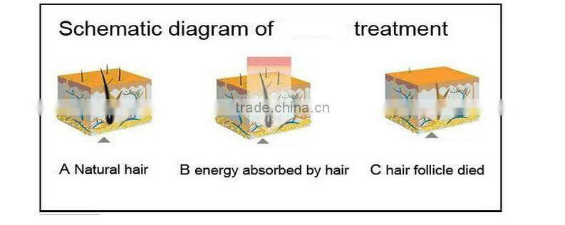 best selling hair laser removal 808 diode laser