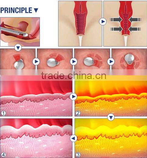 EAG & Co2 fractional laser for vaginal tightening