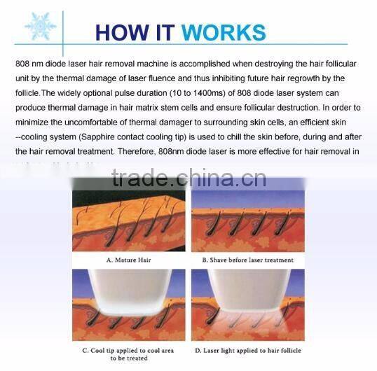 fast hair removal new non channel diode laser