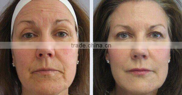 Newly design professional OPT SHR IPL for beauty salon spa clinic use / hair removal IPL machine