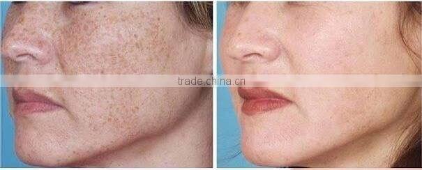 Taibo ODM OEM e-light ipl rf+nd yag laser/E-light +RF +Q-switch nd yag laser tattoo removal hair removal machine 3in1