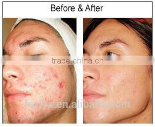 Stainless steel microneedle roller