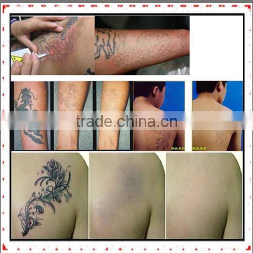 machine for small business rotary machine for tattoo removal Q Switch ND Yag Laser yag 1000 tattoo removal