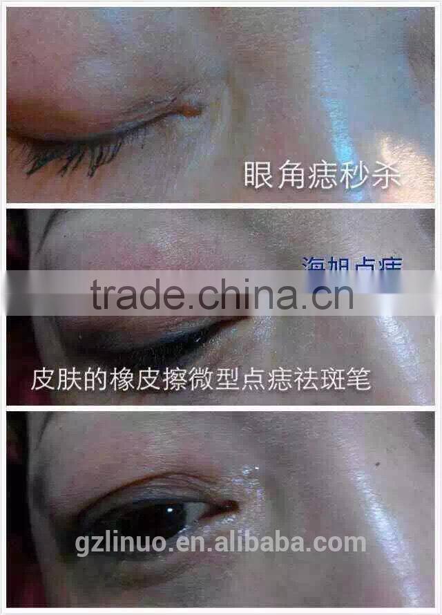 Beauty and health mole removal machine , nevus removal machine