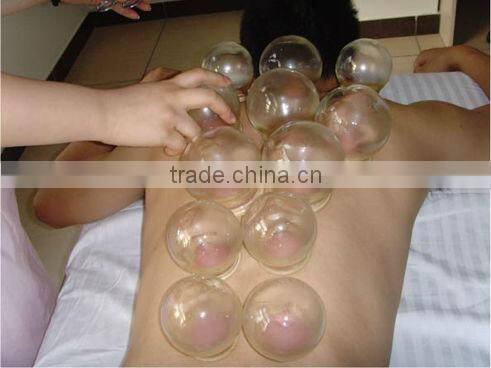 raditional fire cupping, glass cupping