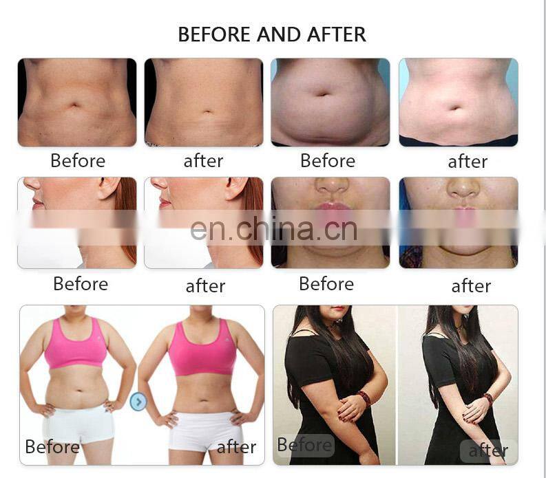 New technology cryo 360 cryolipolysis lose weight machine vaccum cavitation lipo laser pads for fat reduce