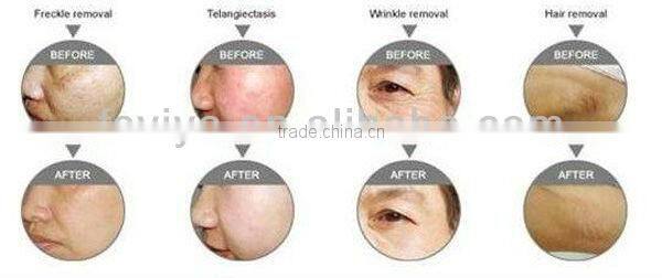 VY-9002 IPL Nd Yag Laser Manufacturers