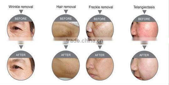 Professional ipl xenon flash lamp