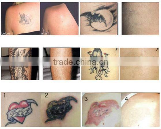 q switched nd yag laser/nd:yag laser