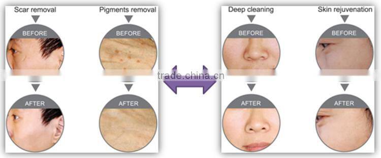 7 in 1 diamond microdermabrasion dead skin removal machine