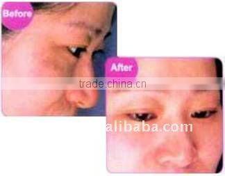 E-light permanent hair removal instrument E-009