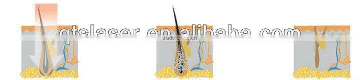 laser diode hair removal 2013 new ultrasound machine