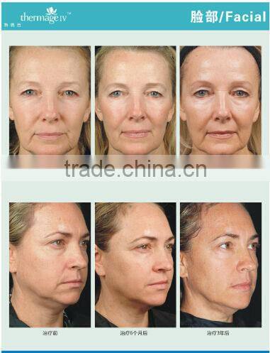rf beauty machine rf equipment rf home use face lift devices AYJ-T28 CE