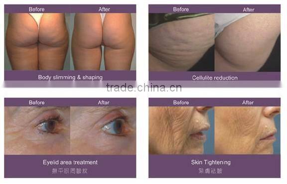 Professional Velaslim vacuum roller laser body slim/body slimming machine