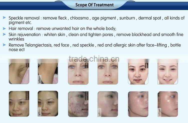 Nubway 2016 professional painless CE approved new hair removal ipl shr machine