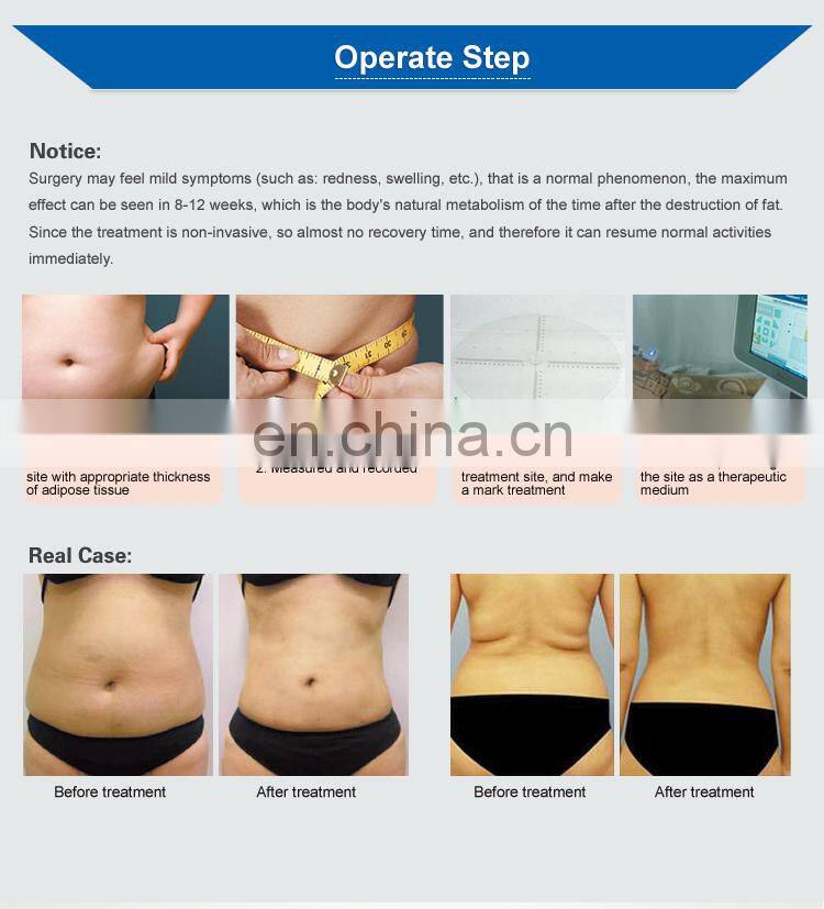 Hifu technology slimming technologoy