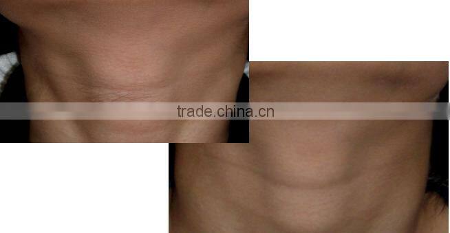 810NM DIODES LASER HAIR REMOVAL machine