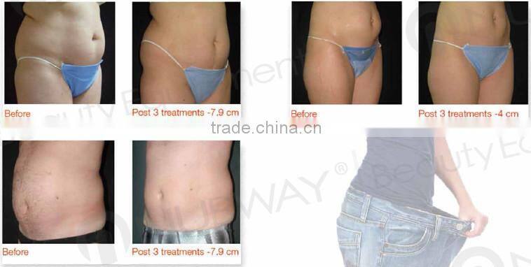 laser weight loss ultrasound weight loss machine