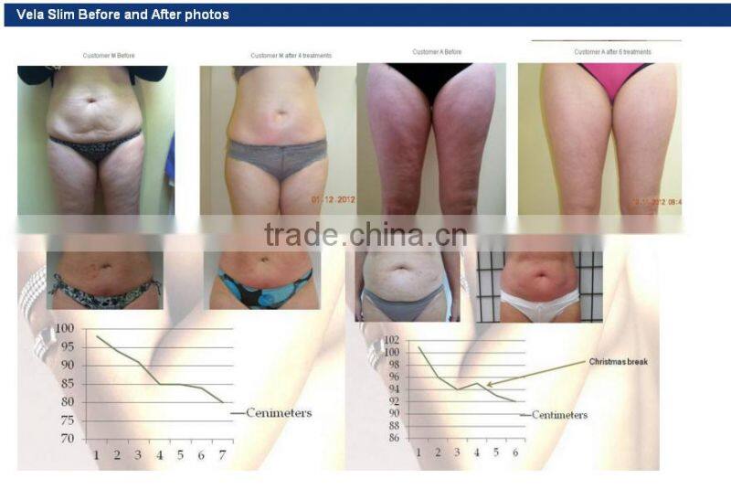 New Products 2016 VelaSlim vacuum massage machine for weight loss