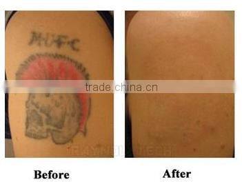 Company Looking for Distributors of Best Product for Pigment Removal Tattoo Removal CE Certified 1064 nm 532nm Nd YAG Laser