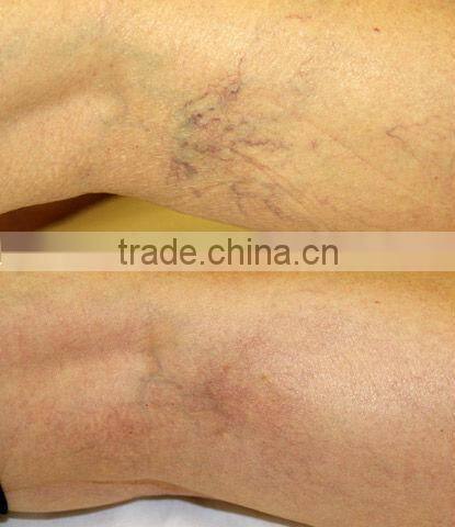 P001 effective clinique epilator hair removal laser