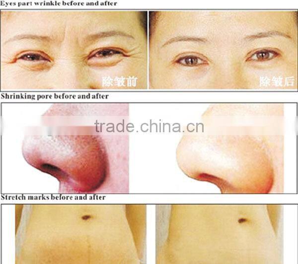 Factory direct wholesale best derma roller/top quality titanium 192 zgts micro needling equipment