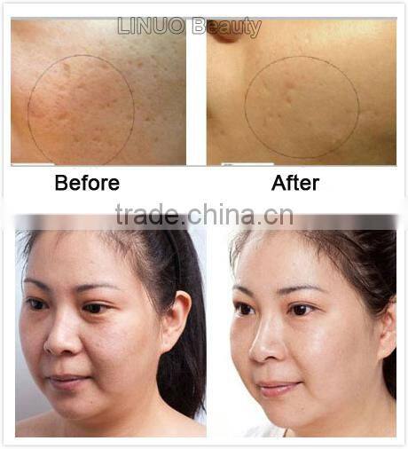 Electric Derma Roller Rechargeable Microneedle Therapy / Auto microneedle electric derma roller