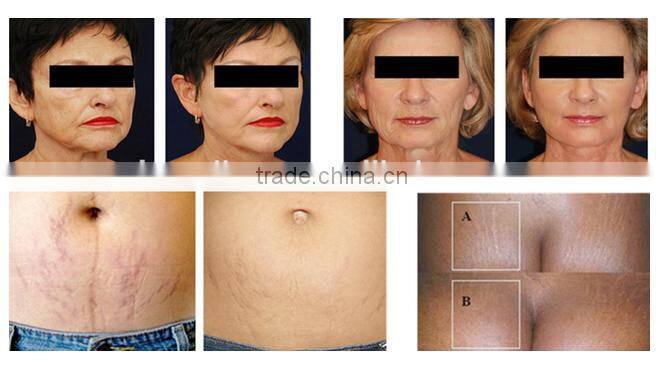 Dermabrasion micro-bubbles dark circles oxygen facial equipment