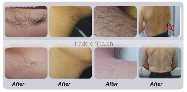 Factory price high quality home use hair removal for Hair Removal beauty equipment&machine