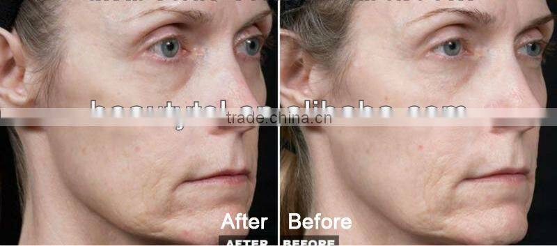 Fractional rf facial microneedle rf fraction machine,Adjustable penetration depth&Adjustable RF treatment output energy