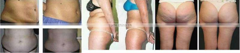 beauty product cavitation rf ultrasonic potable machine