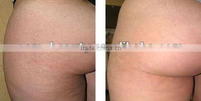 pore minimizing elight ipl machine laser hair removal machine price C001