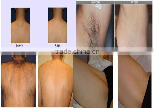 Y9D-Ydel laser diode 808nm without pain / factory price cheap 808 nm diode laser hair removal