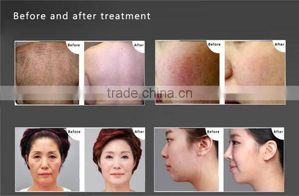 Best Pigment Removal Tattoo Removal Vertical Ipl Rf Nd Yag Laser Hair Removal Machine