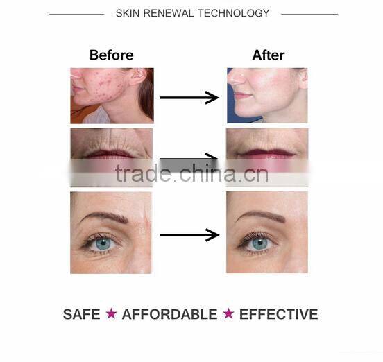 Mts derma meso roller micro needle skin roller 4 in 1 facial massager