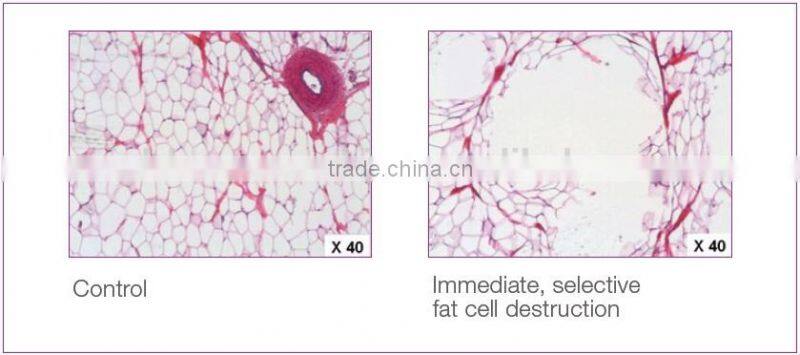 Newest High Intensity focused ultrasound hifu therapy hifushape HIfu slimming
