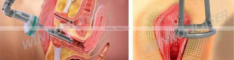 Medical CE approved alibaba hot sell Vaginal Tightening CO2 Fractional laser machine aesthetic cool shape