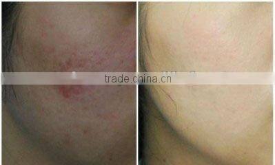 Most popular whitening injection needle free machine H006