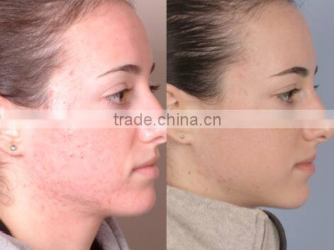 AYJ-G028(CE) Diamond peel face care tool dermabrasion facial brush cleanser