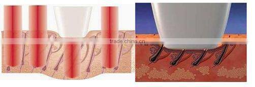Laser Therapy for Skin Rejuvenation/ 808nm Diode Laser Machine