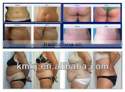 CE approved tripolar rf machine for face lifting with 4 heads