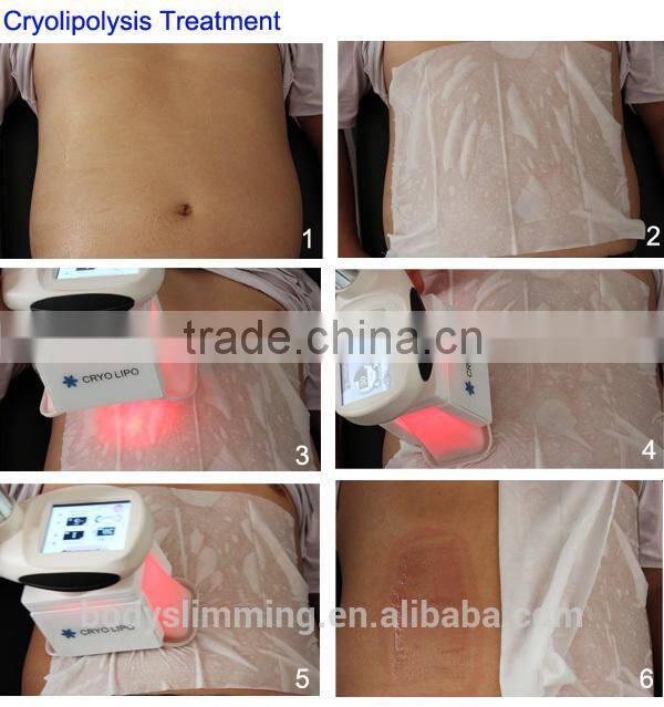Cooling Fat Apparatus / Cryolipolysis / Weight Loss Machine /Cryosuction Vacuum
