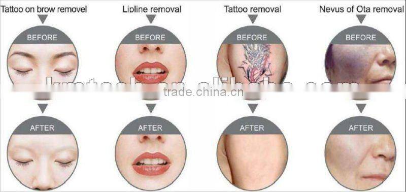 Best Stationary q switch nd yag laser/yag laser systems