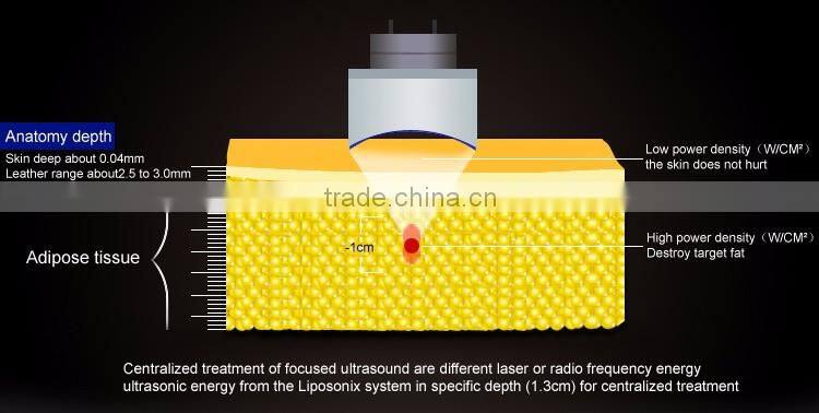 2016 Distributed wanted fat loss slimming device 13mm hifu cartridge