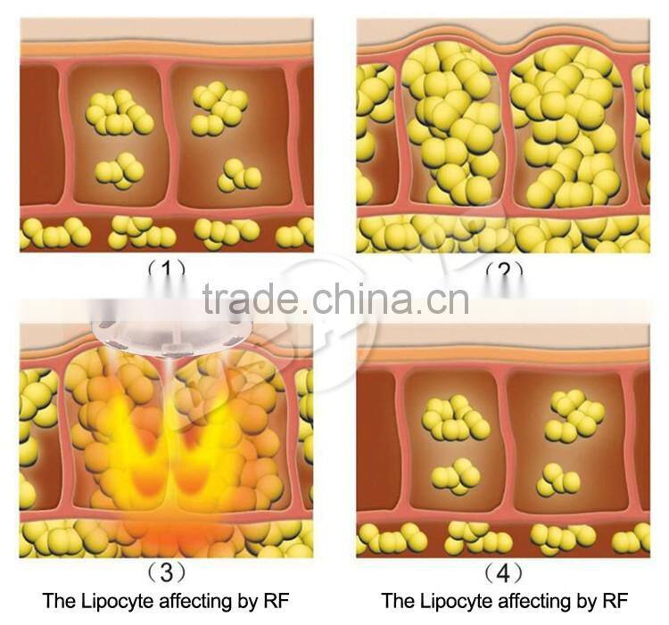 Fat Reducing Machine For Sale Portable Liposuction Machine